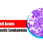 T-cell Acute Lymphoblastic Leukaemia