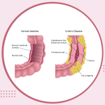 crohn's-disease