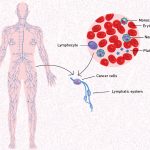 diffuse large B-cell lymphoma (DLBCL).