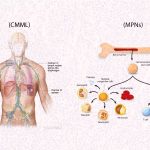 Peripheral T-cell Lymphoma